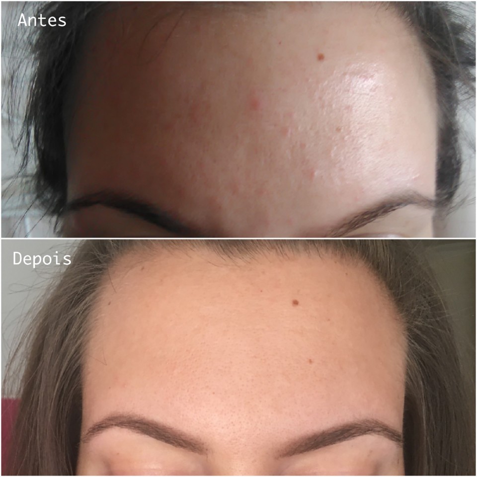 acne fungico antes depois.jpg acne fungico antes depois.jpg